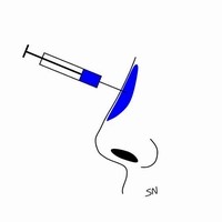 玻尿酸隆鼻 玻尿酸隆鼻