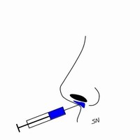 玻尿酸隆鼻 玻尿酸隆鼻