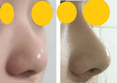 玻尿酸隆鼻 玻尿酸隆鼻