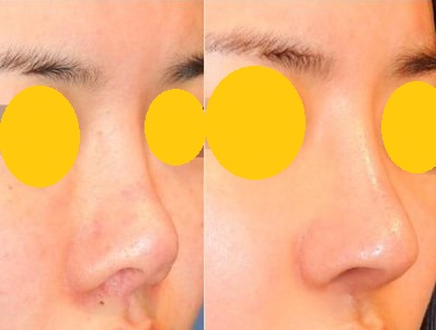 微整形隆鼻 微整形隆鼻