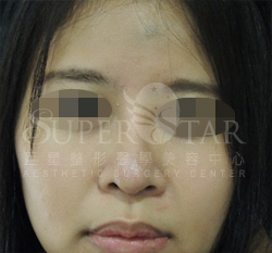 X5韓式隆鼻 X5韓式隆鼻