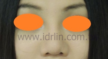 韓式隆鼻術後 韓式隆鼻術後