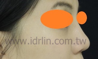 韓式隆鼻術後 韓式隆鼻術後