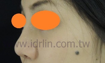 韓式隆鼻術後 韓式隆鼻術後