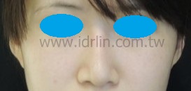 韓式隆鼻 術後 韓式隆鼻 術後