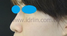 韓式隆鼻 術後 韓式隆鼻 術後