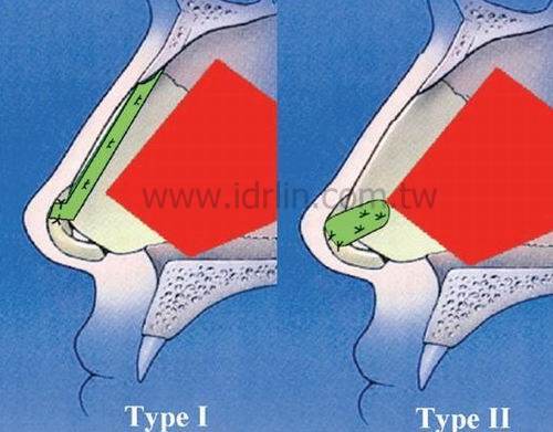 延長移植, extension graft 延長移植, extension graft