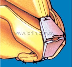 韓式隆鼻 - 帽子移植+延伸盾牌移植 韓式隆鼻 - 帽子移植+延伸盾牌移植