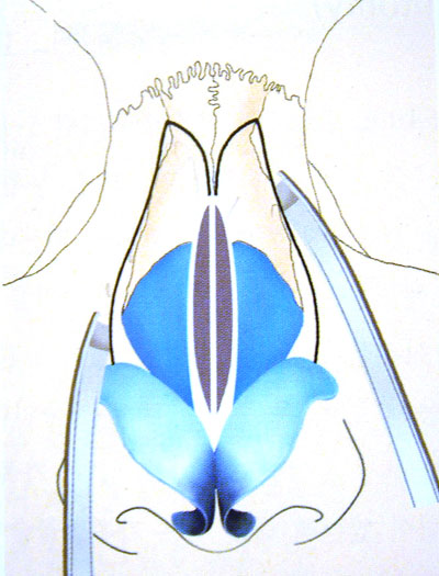 敲鼻骨可使寬鼻變窄,秀氣鼻重生 敲鼻骨可使寬鼻變窄,秀氣鼻重生