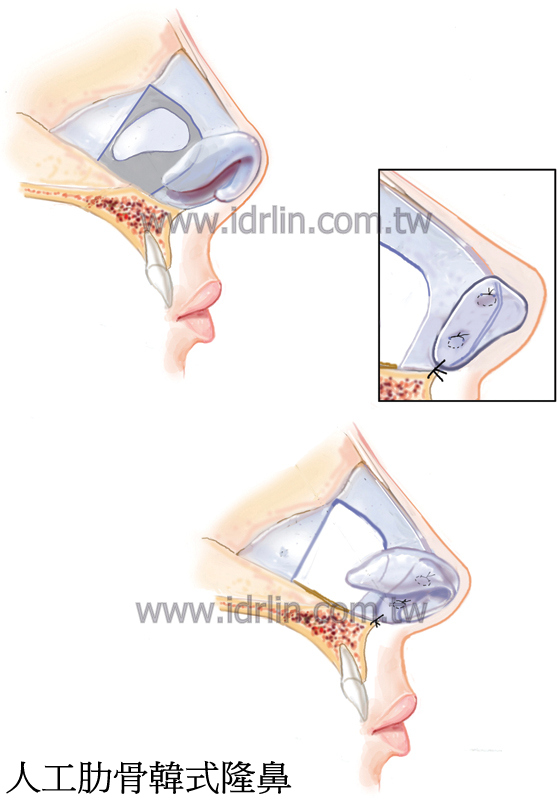 異體肋骨韓式隆鼻 人工肋骨韓式隆鼻