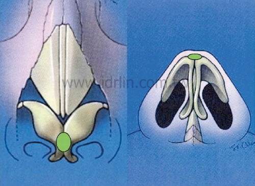 帽子移植(Cap Graft) 帽子移植(Cap Graft)