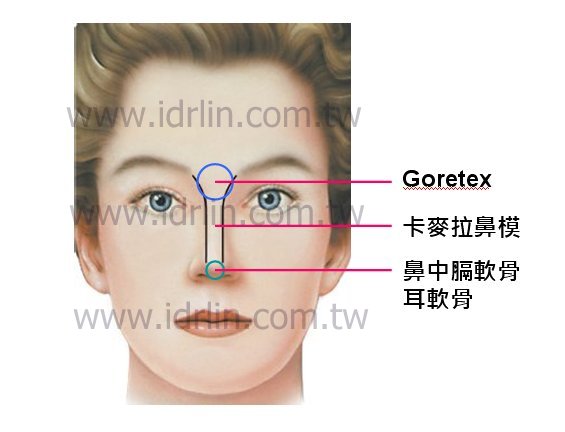三段式隆鼻 三段式隆鼻