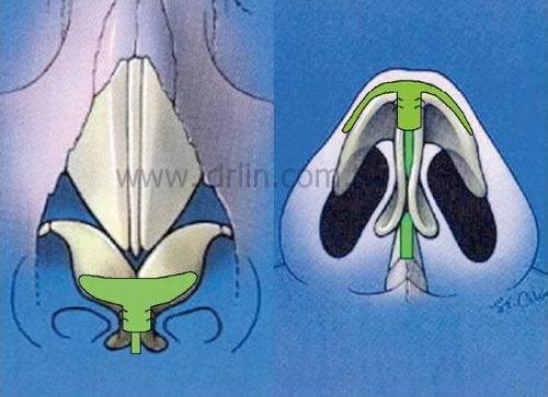 雨傘移植(Umbrella Graft) 雨傘移植(Umbrella Graft)