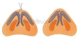 鼻頭軟骨兩兩對縫,以縮小鼻頭 鼻頭軟骨兩兩對縫,以縮小鼻頭