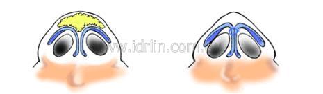 打薄鼻頭皮膚,減少鼻頭組織,放鬆鼻頭張力 打薄鼻頭皮膚,減少鼻頭組織,放鬆鼻頭張力