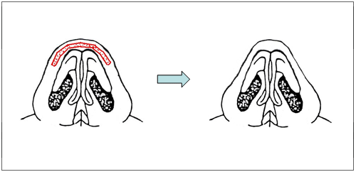 蒜頭鼻隆鼻 蒜頭鼻隆鼻
