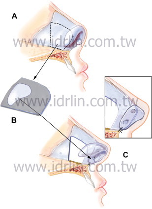 ESG韓式隆鼻 ESG韓式隆鼻