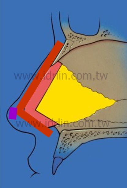 日式隆鼻 日式隆鼻
