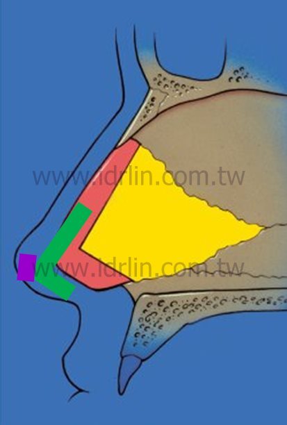 第一代韓式隆鼻 第一代韓式隆鼻