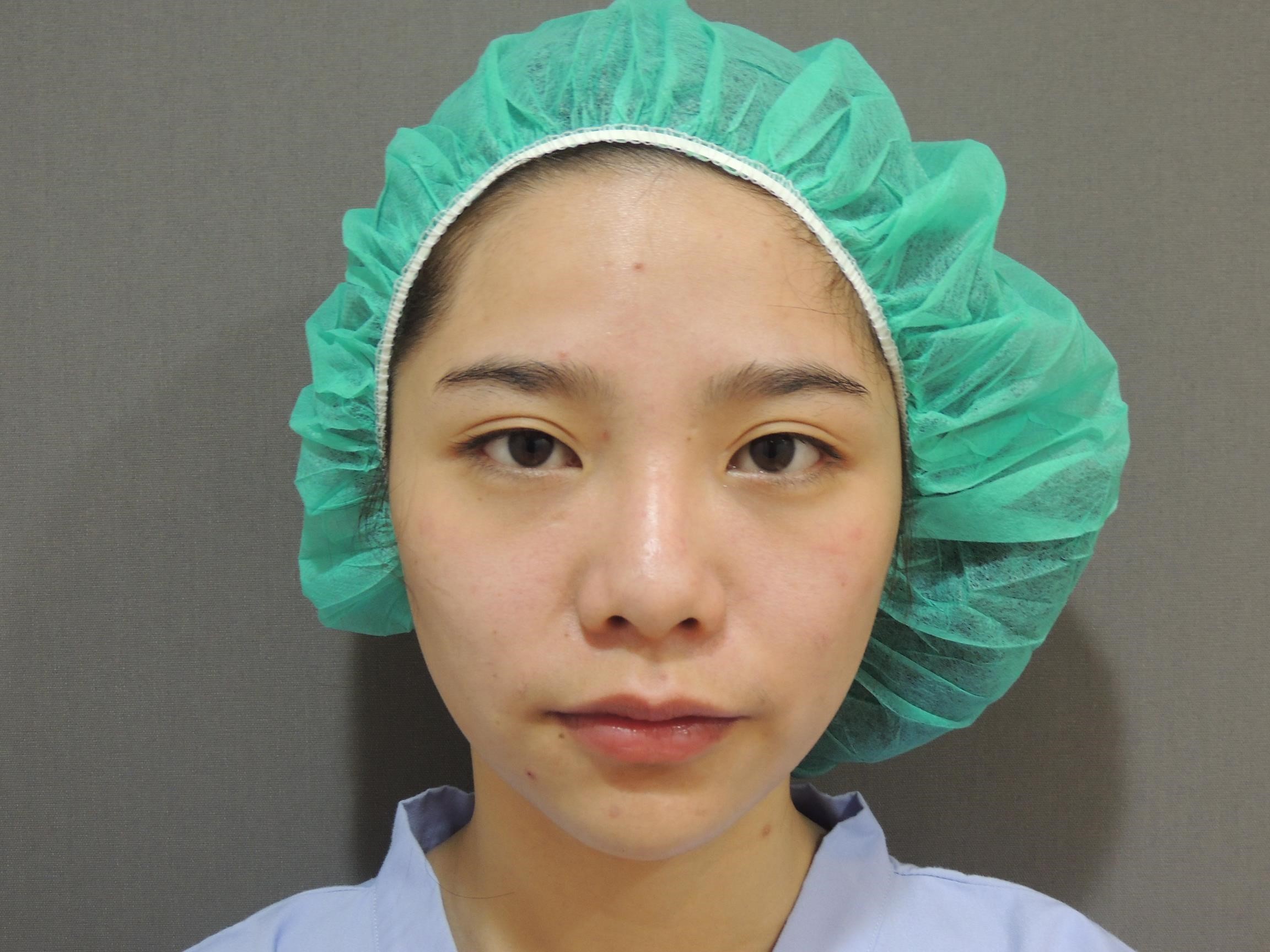 韓式隆鼻 韓式隆鼻