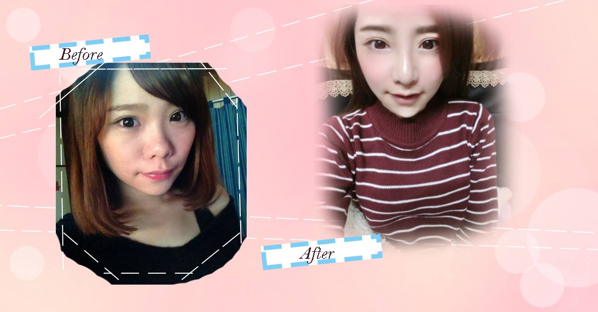 韓式隆鼻 韓式隆鼻