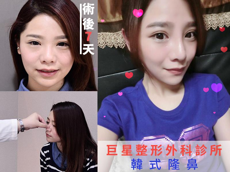 韓式隆鼻 韓式隆鼻