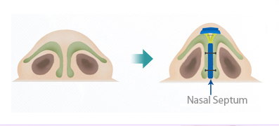 韓式隆鼻以耳朵軟骨塑形 韓式隆鼻以耳朵軟骨作多層堆疊雕塑