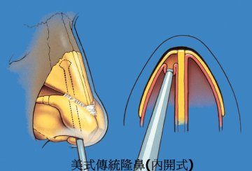 盲目撥離,撥離至骨膜下 盲目撥離至骨膜下