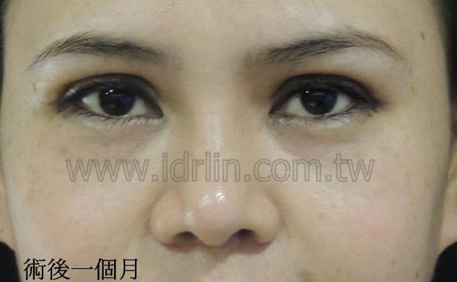 三段式隆鼻+割雙眼皮術後 三段式隆鼻+割雙眼皮術後