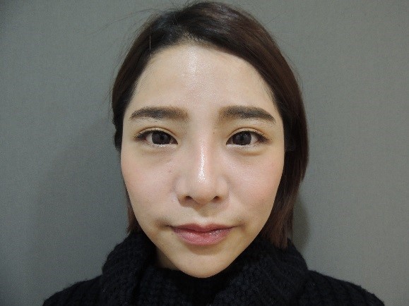 韓式隆鼻 韓式隆鼻