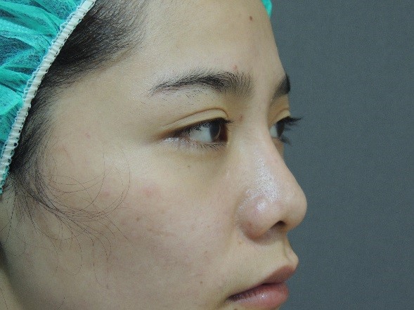 韓式隆鼻 韓式隆鼻