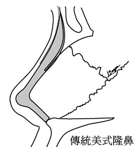 傳統隆鼻 傳統美式隆鼻