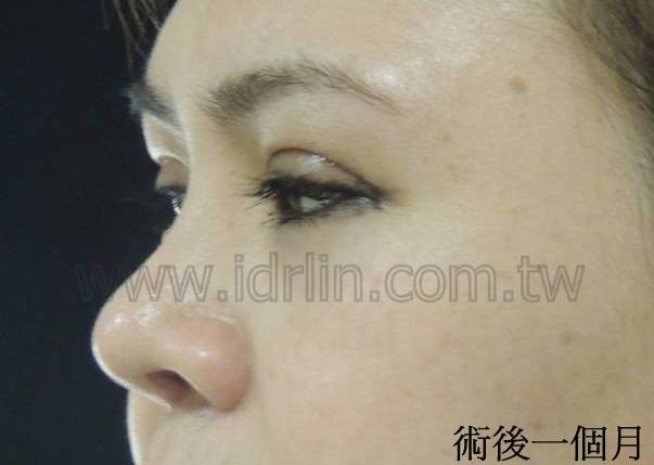 三段式隆鼻+割雙眼皮術後 三段式隆鼻+割雙眼皮術後