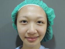 韓式隆鼻案例 韓式隆鼻案例