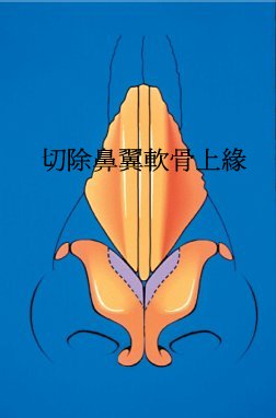切除鼻翼軟骨上緣以縮小鼻頭 切除鼻翼軟骨上緣以縮小鼻頭