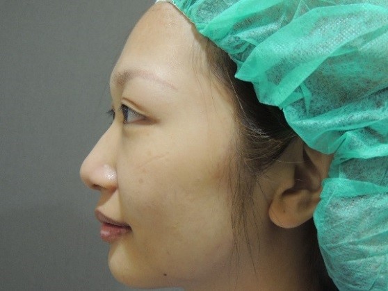 韓式隆鼻案例 韓式隆鼻案例