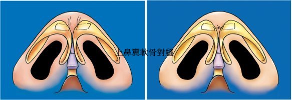 上鼻翼軟骨對縫以縮小鼻頭 上鼻翼軟骨對縫以縮小鼻頭