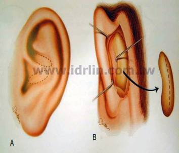 韓式隆鼻 - 取耳朵軟骨 韓式隆鼻 - 取耳朵軟骨