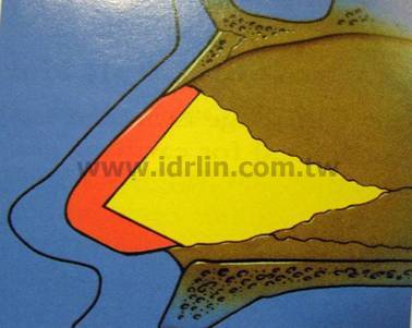 二段式隆鼻 - 取鼻中膈軟骨 二段式隆鼻 - 取鼻中膈軟骨