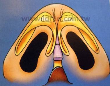 二段式隆鼻 - 縮小鼻頭 二段式隆鼻 - 縮小鼻頭