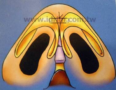 韓式隆鼻 - 雕塑鼻頭 韓式隆鼻 - 雕塑鼻頭