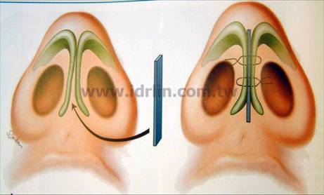 韓式隆鼻 - 延長鼻子 韓式隆鼻 - 延長鼻子