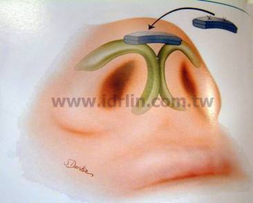 韓式隆鼻 - 雕塑鼻頭, 延長鼻形 韓式隆鼻 - 雕塑鼻頭, 延長鼻形