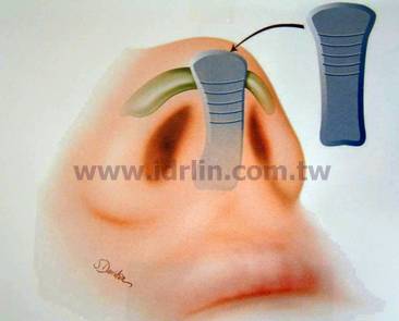 二段式隆鼻 - 延長鼻型 二段式隆鼻 - 延長鼻型