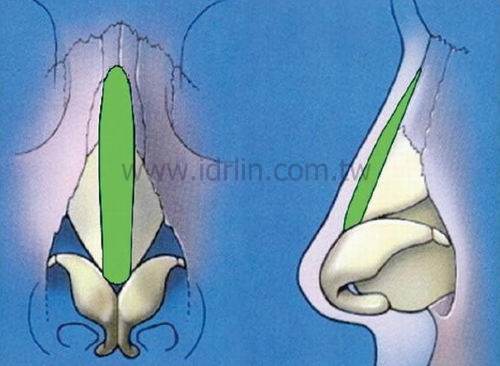 以卡麥拉墊高山根鼻樑 以卡麥拉墊高山根鼻樑