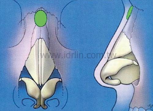 鼻根移植 鼻根移植