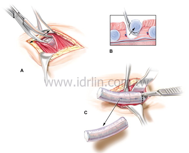 全自體肋骨 韓式隆鼻 全自體肋骨 韓式隆鼻