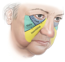 筋膜懸吊拉皮 筋膜懸吊拉皮