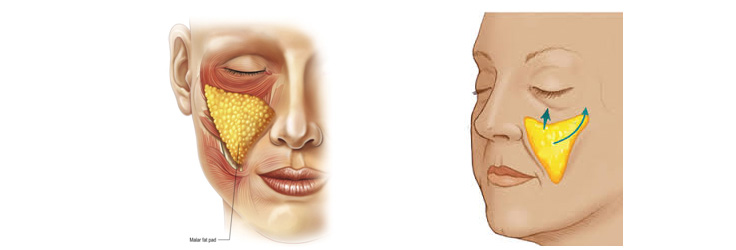 臉部老化下垂 - 拉皮 臉部老化下垂 - 拉皮
