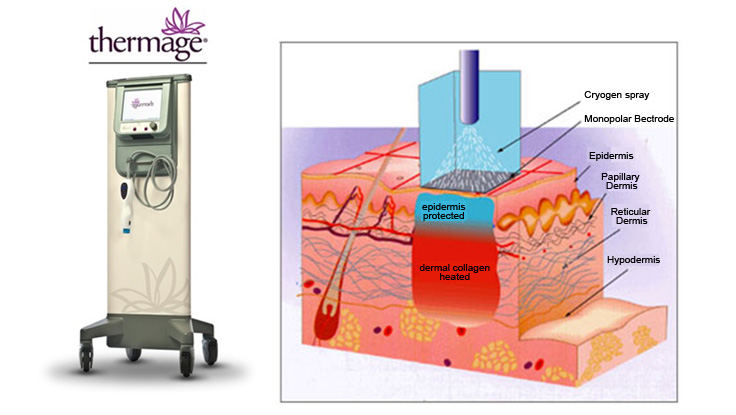 Thermage CPT電波拉皮 Thermage CPT電波拉皮